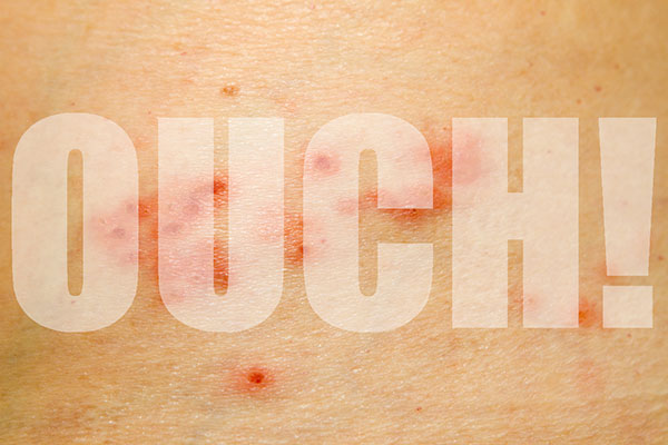 close-up of shingles with the word Ouch superimposed. 